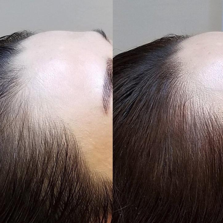 microblading hairline