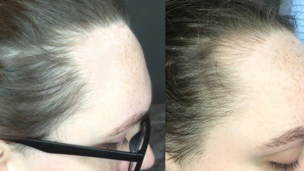 Microblading Hairline